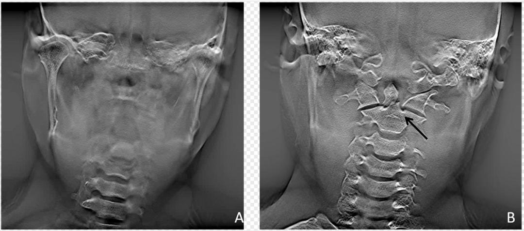 dr数字怎么用数字化X线摄影术（DR）_https://www.jmylbn.com_新闻资讯_第4张