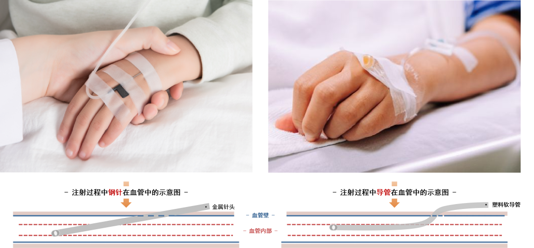 为什么输血不能用小针输液时打的“留置针”是什么？_https://www.jmylbn.com_新闻资讯_第6张