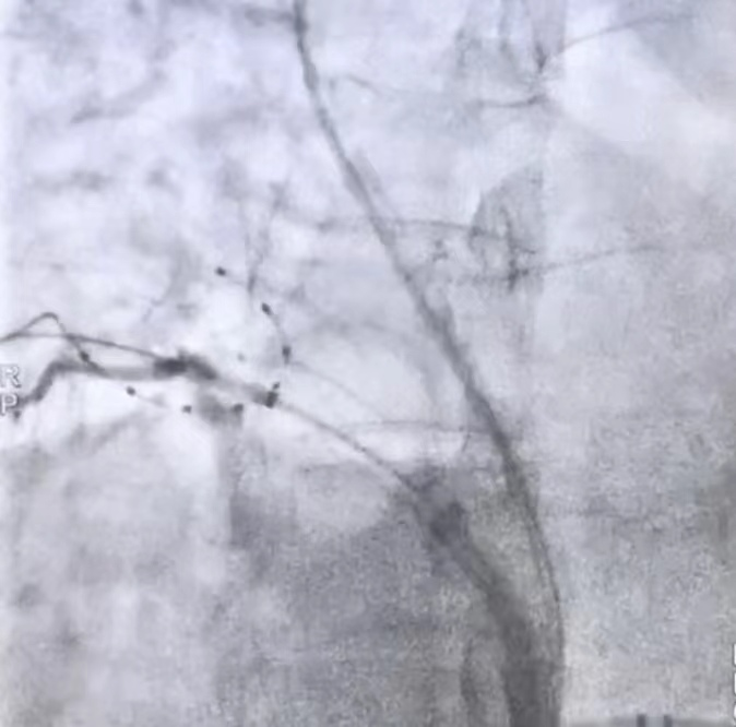 首次！房颤冷冻消融术落地西安高新医院，让「失控」的心脏回归平静