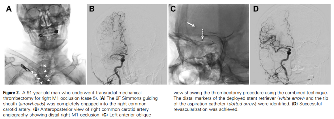 桡动脉鞘怎么读使用桡动脉专用神经介入导管鞘经桡动脉机械取栓治疗前循环大血管闭塞：初步经验和文献回顾_https://www.jmylbn.com_新闻资讯_第5张