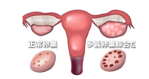 【生酮治療】多囊卵巢綜合症的生酮治療 健康 第2張