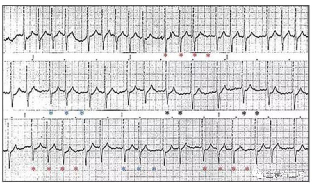 六種可能致命的異常心電圖特征！ 健康 第4張