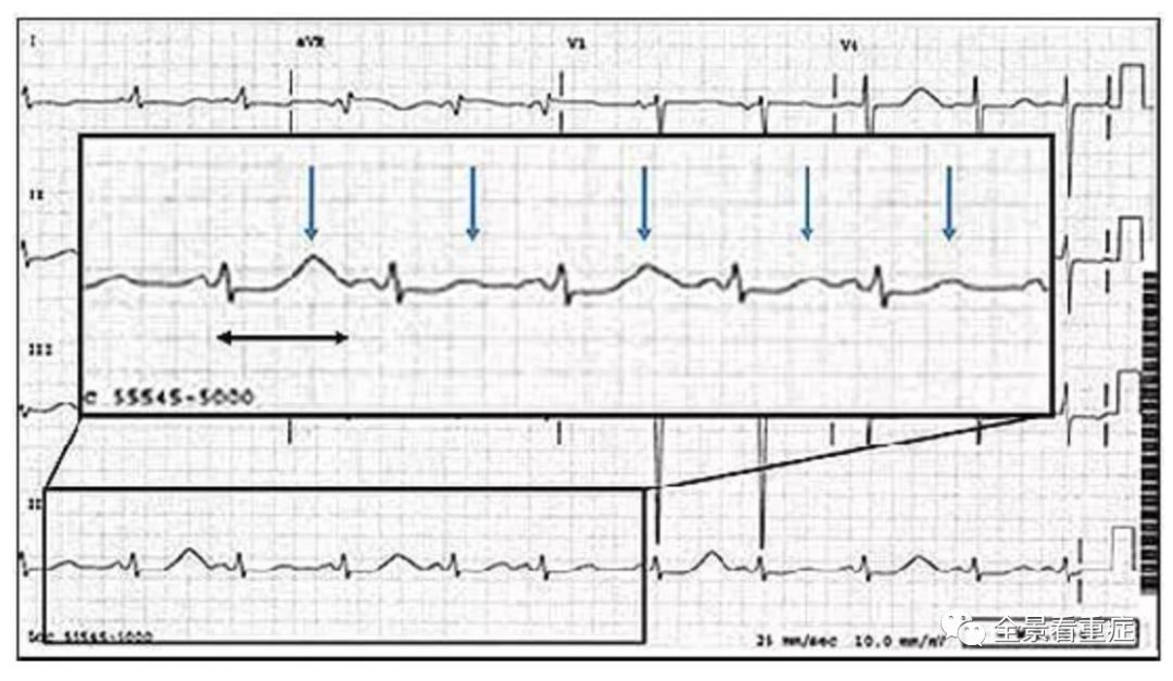 六種可能致命的異常心電圖特征！ 健康 第3張