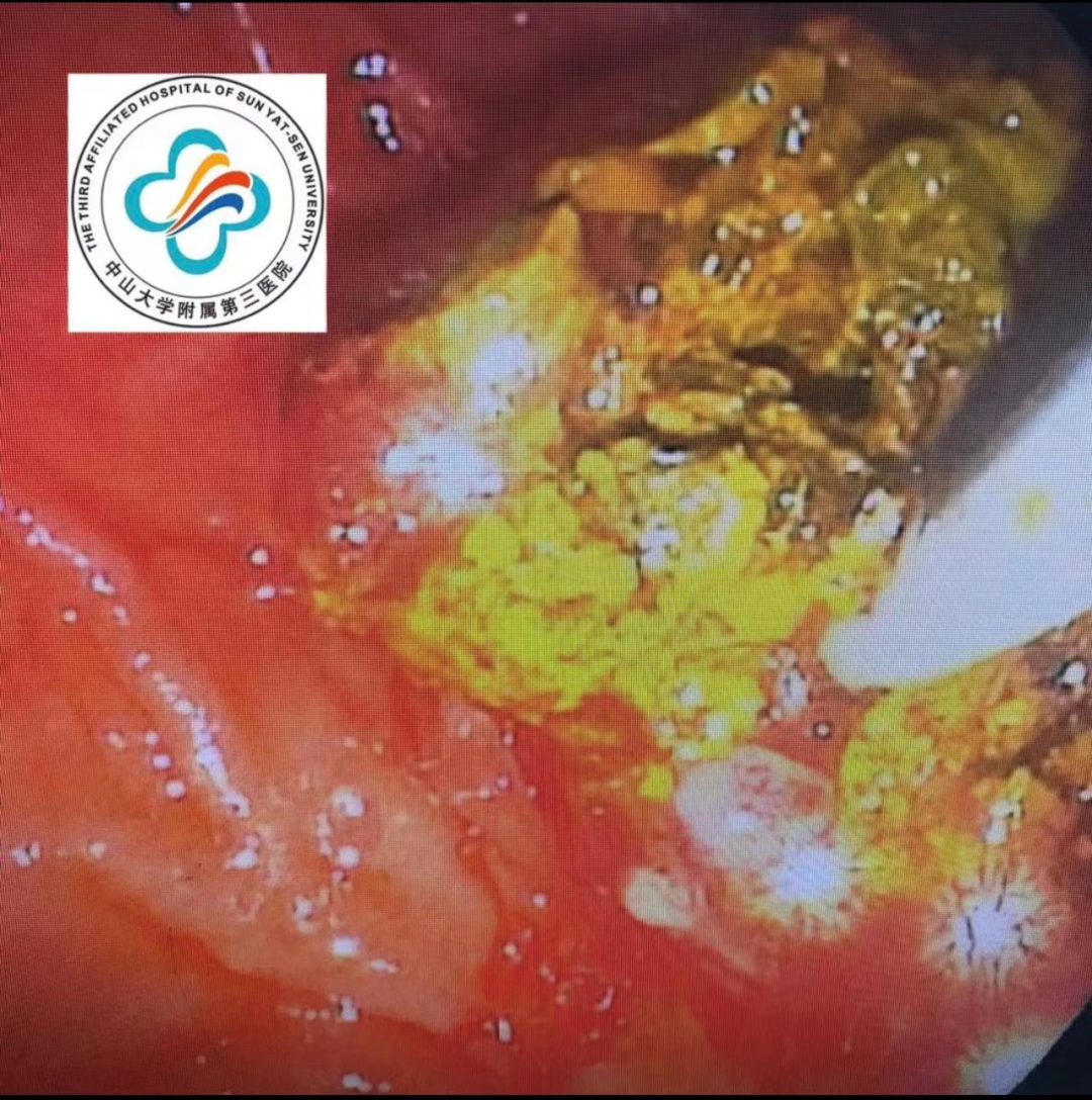 取石网篮 为什么贵小小胆石危害大，内镜妙手助健康——内镜ERCP取石术，胆管结石患者的福音_https://www.jmylbn.com_新闻资讯_第1张