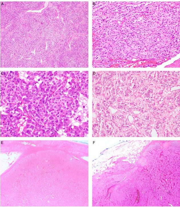 fh染色是什么意思【前沿编译】FH缺失型嗜铬细胞瘤和副神经节瘤的临床病理和分子特征分析_https://www.jmylbn.com_新闻资讯_第6张
