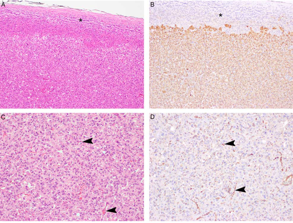 fh染色是什么意思【前沿编译】FH缺失型嗜铬细胞瘤和副神经节瘤的临床病理和分子特征分析_https://www.jmylbn.com_新闻资讯_第8张