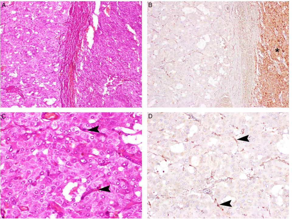 fh染色是什么意思【前沿编译】FH缺失型嗜铬细胞瘤和副神经节瘤的临床病理和分子特征分析_https://www.jmylbn.com_新闻资讯_第9张