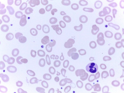 rbc直方图怎么看提示RBC碎片？血片镜检一探究竟_https://www.jmylbn.com_新闻资讯_第6张