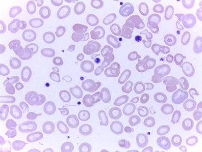 rbc直方图怎么看提示RBC碎片？血片镜检一探究竟_https://www.jmylbn.com_新闻资讯_第7张