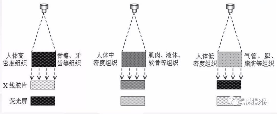 x光是什么原理分享‖体外碎石中X线与超声是如何定位结石的？_https://www.jmylbn.com_新闻资讯_第1张