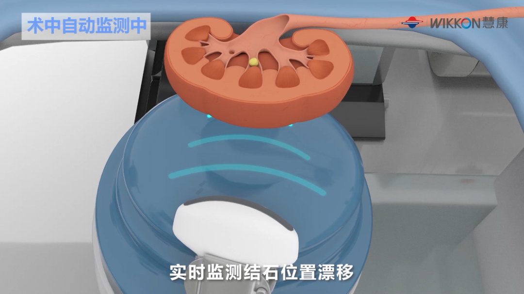 x光是什么原理分享‖体外碎石中X线与超声是如何定位结石的？_https://www.jmylbn.com_新闻资讯_第6张