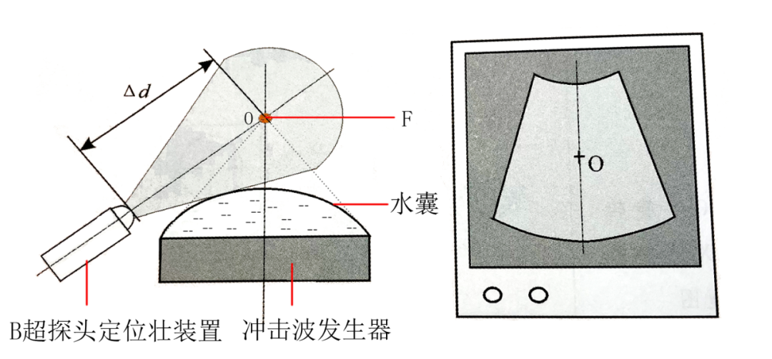 x光是什么原理分享‖体外碎石中X线与超声是如何定位结石的？_https://www.jmylbn.com_新闻资讯_第3张
