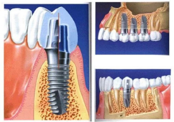 口腔ct怎么拍摄【科普】什么是牙科CT？牙科CT在种植牙中的运用_https://www.jmylbn.com_新闻资讯_第4张