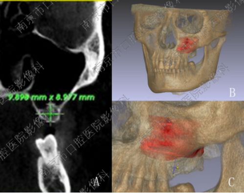 口腔ct怎么拍摄【科普】什么是牙科CT？牙科CT在种植牙中的运用_https://www.jmylbn.com_新闻资讯_第7张