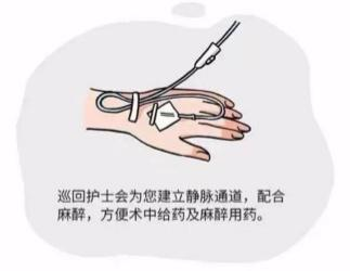 为什么要用动脉留置针【科普】手术“针”的不一样_https://www.jmylbn.com_新闻资讯_第6张