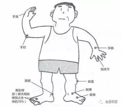 哪些部位易发痛风