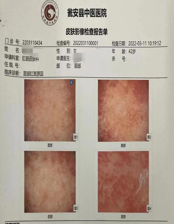 电子皮肤镜有什么用【新项目】瓮安县中医医院肛肠皮肤科引进两神器--电子皮肤镜、电子直肠镜！_https://www.jmylbn.com_新闻资讯_第16张