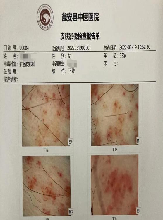 电子皮肤镜有什么用【新项目】瓮安县中医医院肛肠皮肤科引进两神器--电子皮肤镜、电子直肠镜！_https://www.jmylbn.com_新闻资讯_第14张