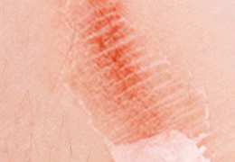 医院DR怎么消毒液体创可贴：促进湿性愈合，消毒防护，有娃必备！_https://www.jmylbn.com_新闻资讯_第20张