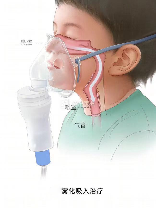 儿童雾化器怎么使用儿童居家雾化，做对几点事半功倍！_https://www.jmylbn.com_新闻资讯_第4张