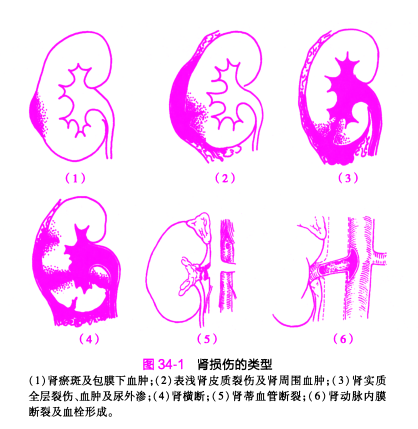 什么是引流袋系统外科护理学 ｜ 泌尿系统损伤病人的护理-上海聚慕医疗器械有限公司