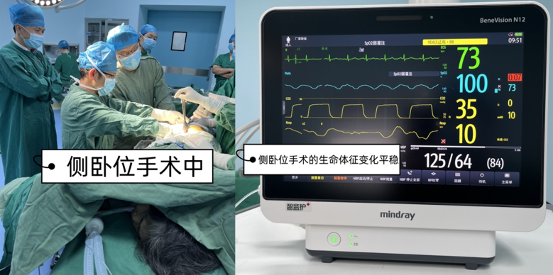 喉罩是什么【科普】喉罩—麻醉科的利器_https://www.jmylbn.com_新闻资讯_第5张