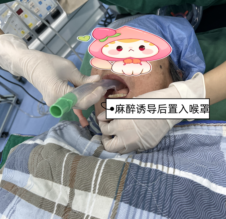 喉罩是什么【科普】喉罩—麻醉科的利器_https://www.jmylbn.com_新闻资讯_第3张