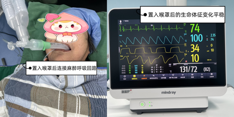 喉罩是什么【科普】喉罩—麻醉科的利器_https://www.jmylbn.com_新闻资讯_第4张