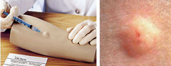 无痛皮试怎么做无痛皮试 ｜ 孩子皮试不再痛，家长省心又放心！_https://www.jmylbn.com_新闻资讯_第14张