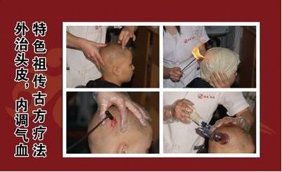 外治头皮，内调气血