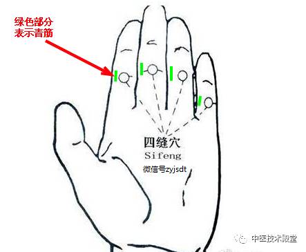 紮四縫，很管用，護理操作熟練還不疼！ 健康 第2張