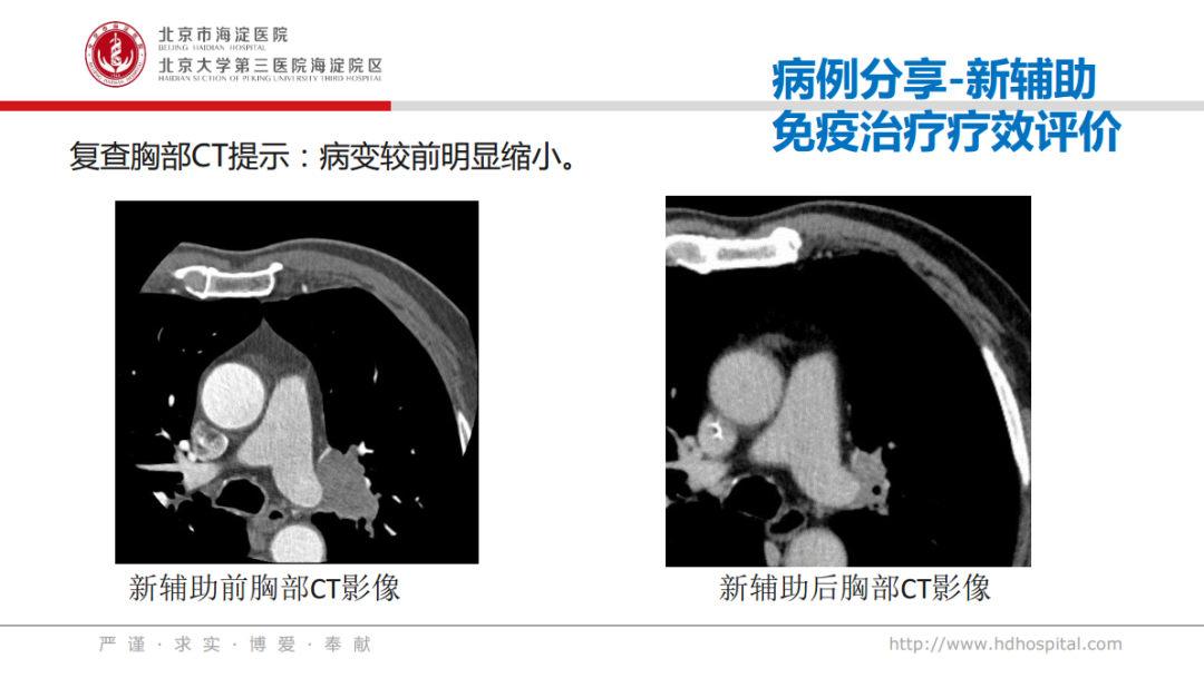 i Hope 學院 | 黃宇清教授病例分享：免疫新輔助治療後行左肺葉切除術 健康 第12張