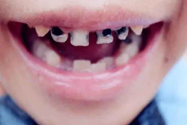 小心！口腔溃疡可能是舌癌中晚期- 全网搜