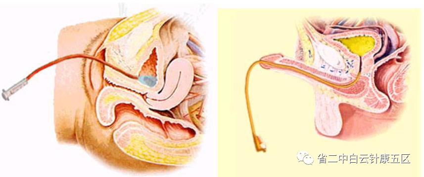 导尿计怎么用我不想留尿管了！太不方便了...有什么办法？_https://www.jmylbn.com_新闻资讯_第3张