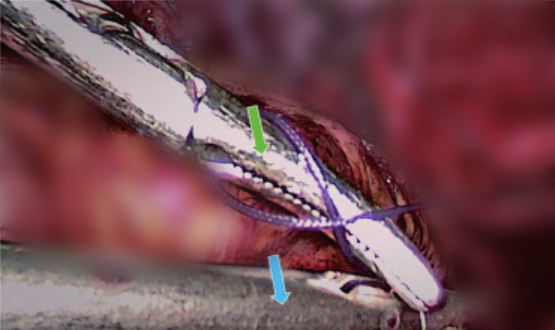 缝合时怎么持钳打结笨手笨脚？妇科腹腔镜不同部位的缝合技巧，多图+视频教学，包教包会→_https://www.jmylbn.com_新闻资讯_第4张