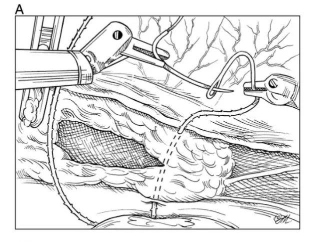 缝合时怎么持钳打结笨手笨脚？妇科腹腔镜不同部位的缝合技巧，多图+视频教学，包教包会→_https://www.jmylbn.com_新闻资讯_第5张