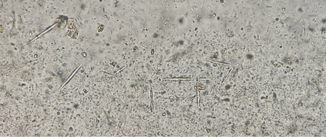 粪便常规仪器怎么用形态学138：粪便-夏科雷登结晶（仪器辅助判断）_https://www.jmylbn.com_新闻资讯_第9张