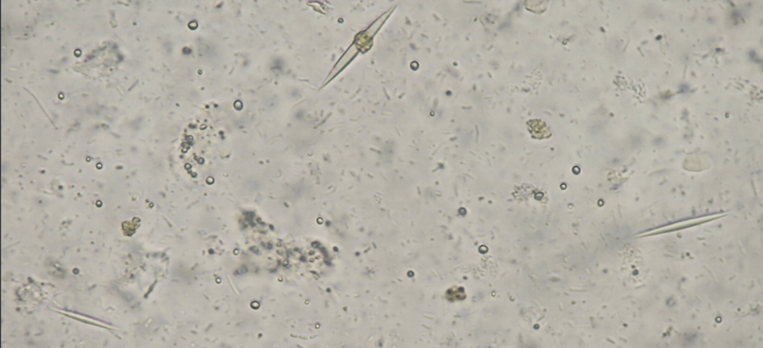 粪便常规仪器怎么用形态学138：粪便-夏科雷登结晶（仪器辅助判断）_https://www.jmylbn.com_新闻资讯_第7张