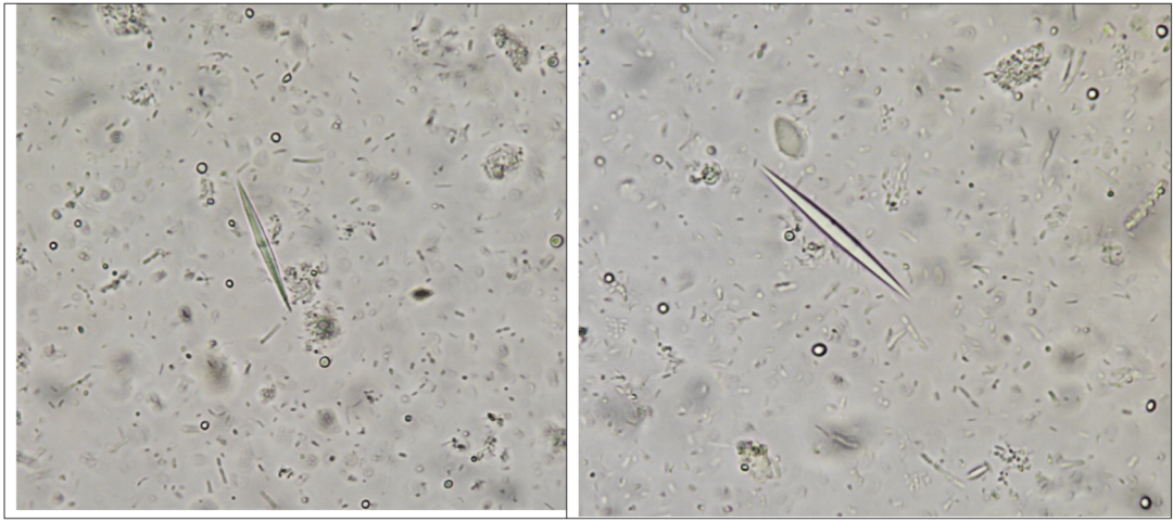 粪便常规仪器怎么用形态学138：粪便-夏科雷登结晶（仪器辅助判断）_https://www.jmylbn.com_新闻资讯_第5张