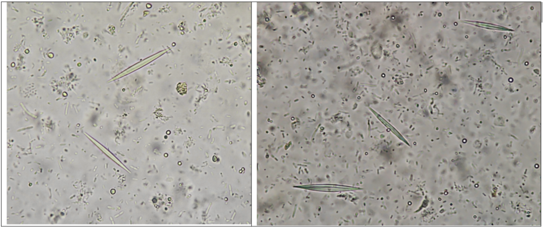 粪便常规仪器怎么用形态学138：粪便-夏科雷登结晶（仪器辅助判断）_https://www.jmylbn.com_新闻资讯_第6张