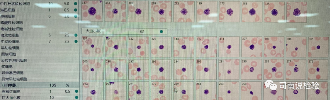 rbc直方图怎么看知识点058：说说红细胞直方图_https://www.jmylbn.com_新闻资讯_第29张