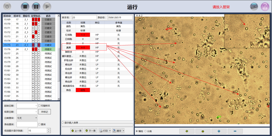 粪便常规仪器怎么用形态学142：粪便-真菌（白色念珠菌）（仪器辅助判断）_https://www.jmylbn.com_新闻资讯_第4张