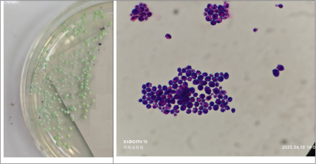 粪便常规仪器怎么用形态学142：粪便-真菌（白色念珠菌）（仪器辅助判断）_https://www.jmylbn.com_新闻资讯_第9张