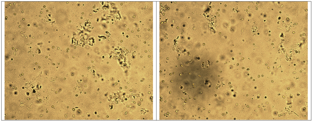 粪便常规仪器怎么用形态学142：粪便-真菌（白色念珠菌）（仪器辅助判断）_https://www.jmylbn.com_新闻资讯_第5张