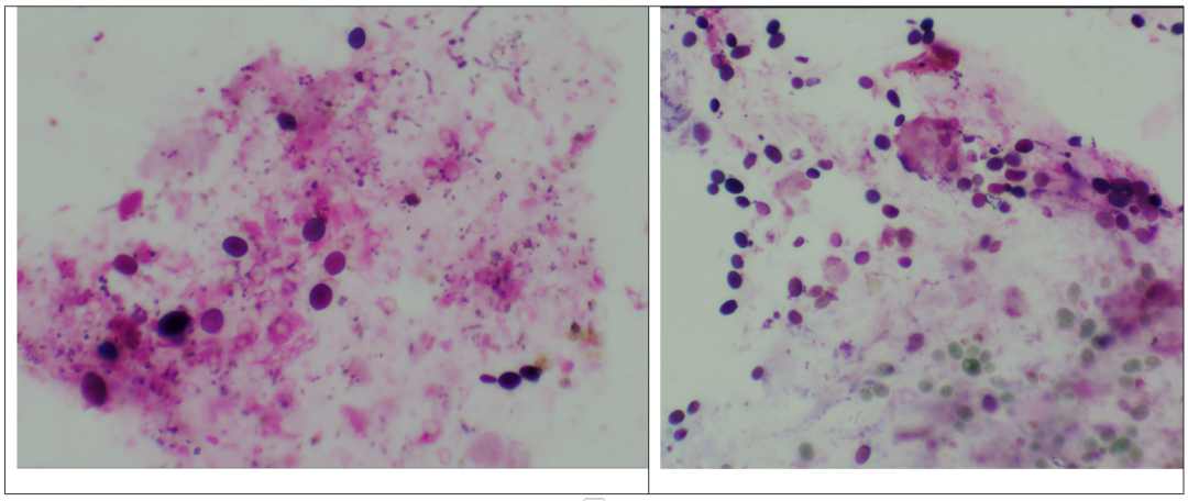 粪便常规仪器怎么用形态学142：粪便-真菌（白色念珠菌）（仪器辅助判断）_https://www.jmylbn.com_新闻资讯_第8张