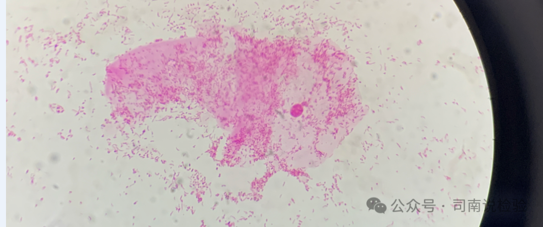 bv唾液酸酶阴性什么意思你问我答111：阴道分泌物检查中细菌性阴道炎（BV）时唾液酸苷酶一定阳性吗？_https://www.jmylbn.com_新闻资讯_第8张