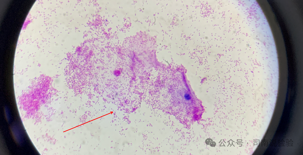 bv唾液酸酶阴性什么意思你问我答111：阴道分泌物检查中细菌性阴道炎（BV）时唾液酸苷酶一定阳性吗？_https://www.jmylbn.com_新闻资讯_第6张