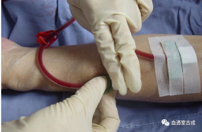 医用弹力绷带怎么取血液透析动静脉内瘘拔针止血，弹力绷带的规范使用_https://www.jmylbn.com_新闻资讯_第5张