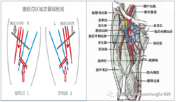 中心静脉穿刺点图片