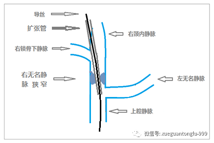 中心静脉穿刺三思而后行